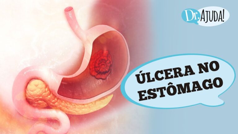 Ulcera no Estômago: Riscos e Consequências Fatais